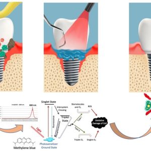 Maintenance/Periimplantitis