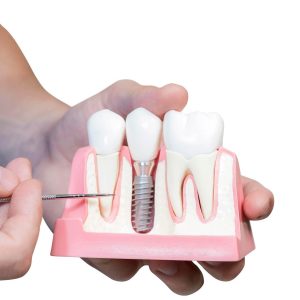 Implant prosthodontics