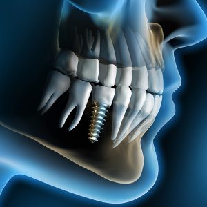 Basics of implant dentistry